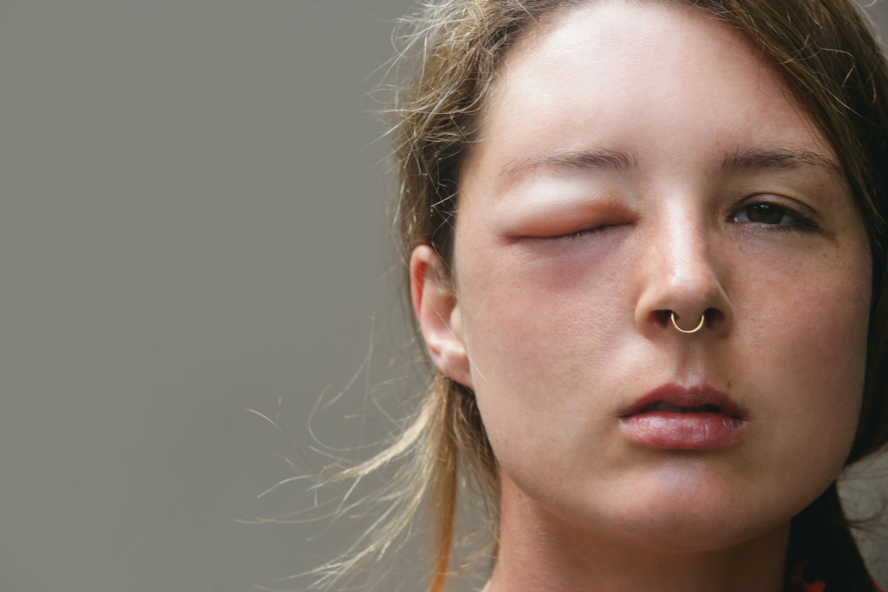 Mehr als nur Schwellungen: 11 alltägliche Symptome, die auf HAE hindeuten können